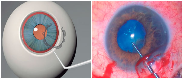 the Curious Case of the Nondilating pupil